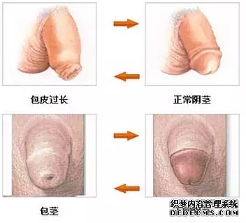 阿拉尔包皮费用全解