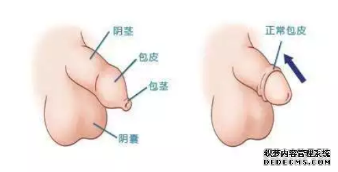 昌吉阿瓦提县男科医院割包皮